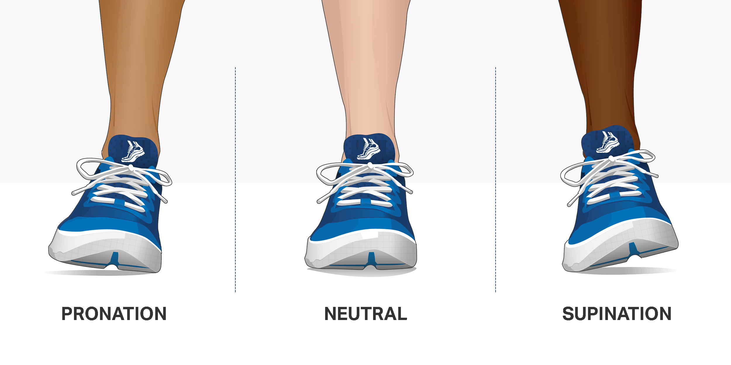 Orthotics for Common Foot Ailments - Pronation & Supination